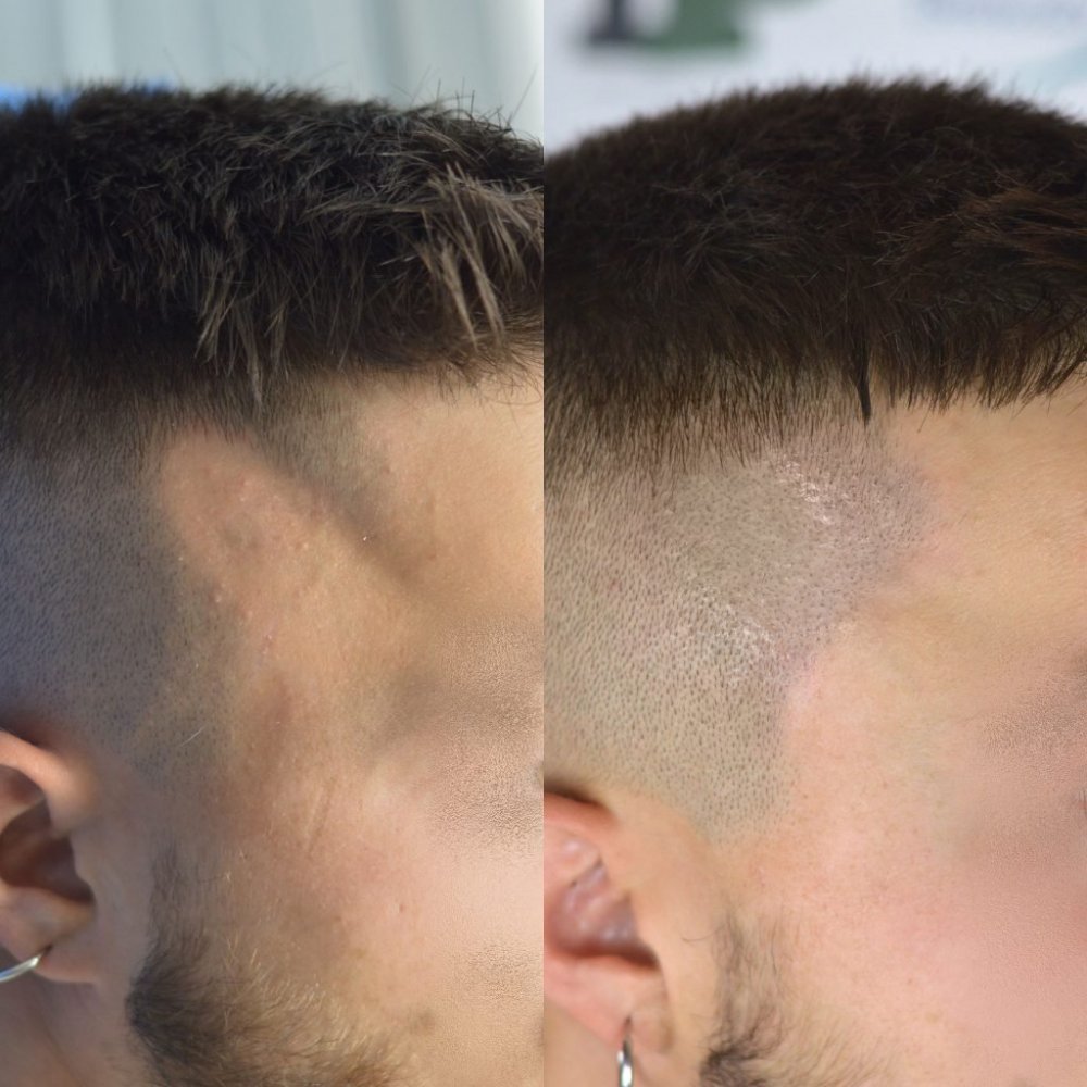 alopecia trico3.jpg