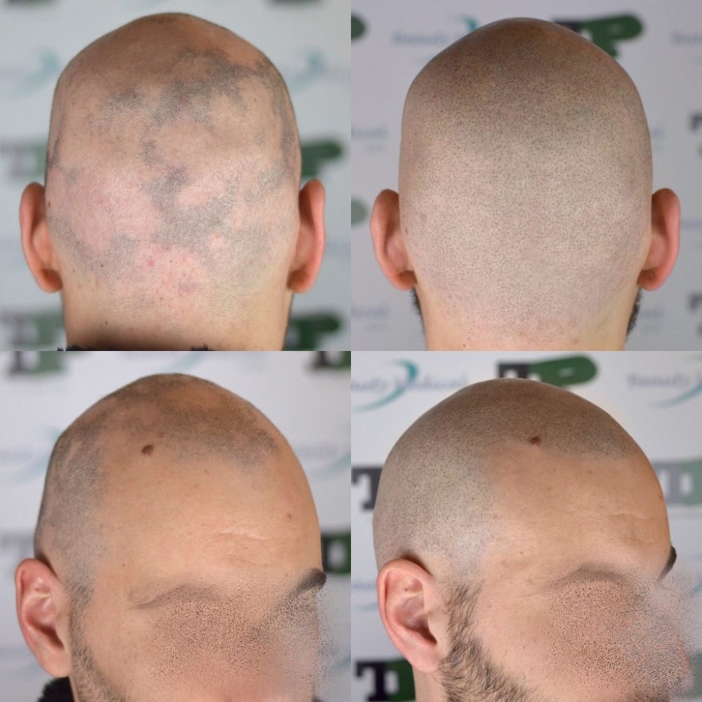 alopecia1.jpg