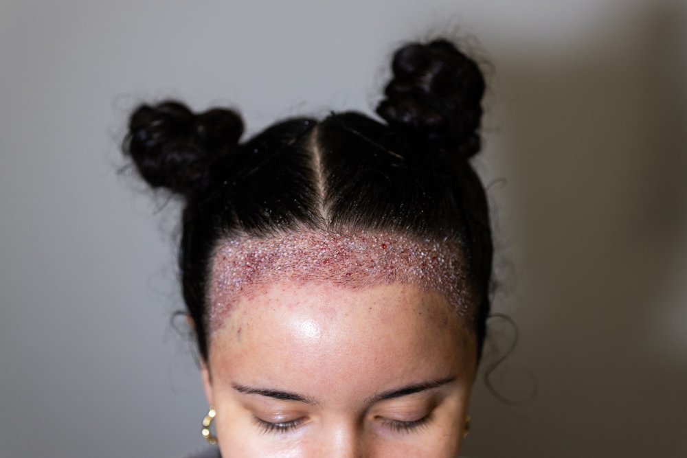 Aria's new hairline immediately after her hair transplant by Dr Ball at The Maitland Clinic.