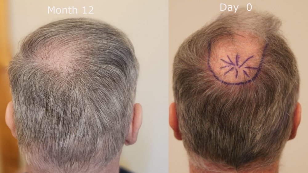back month 12 v month 0.jpg