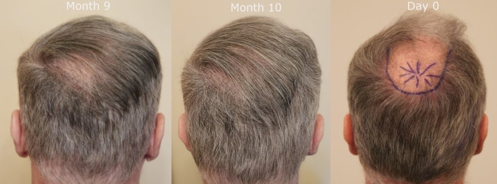 back month 9 v month 10 v Day 0.jpg