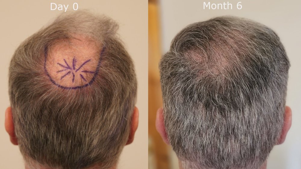back month0 v month6.jpg