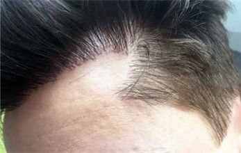 badly-angled-hairline.jpg