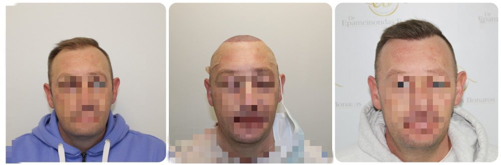 before-after-12-months-hair-transplant-glasgow-scotland.jpg