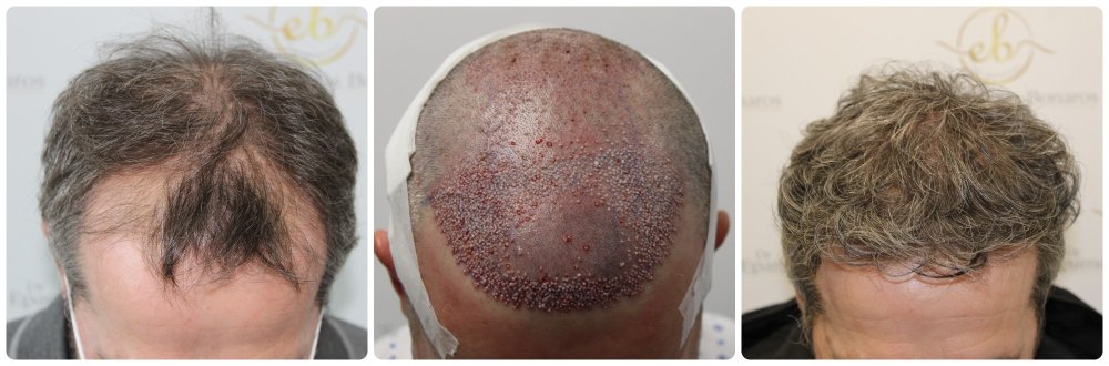before-after-4000-grafts-dr-bonaros-hair-transplant.jpg