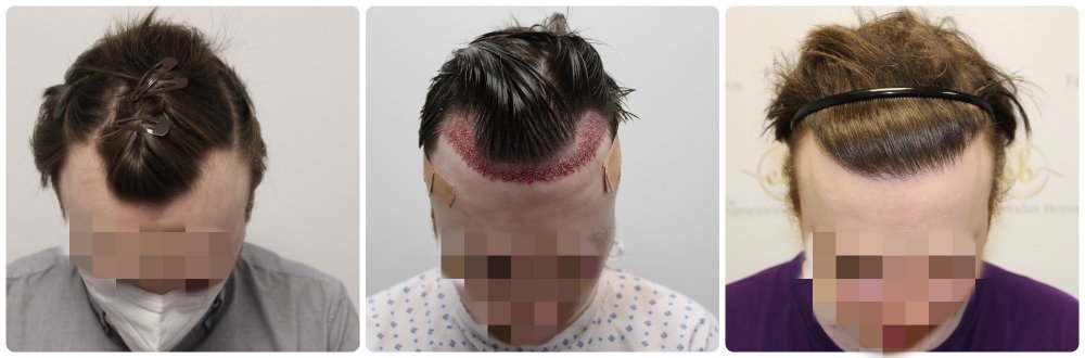 before-after-fue-dr-bonaros.jpg
