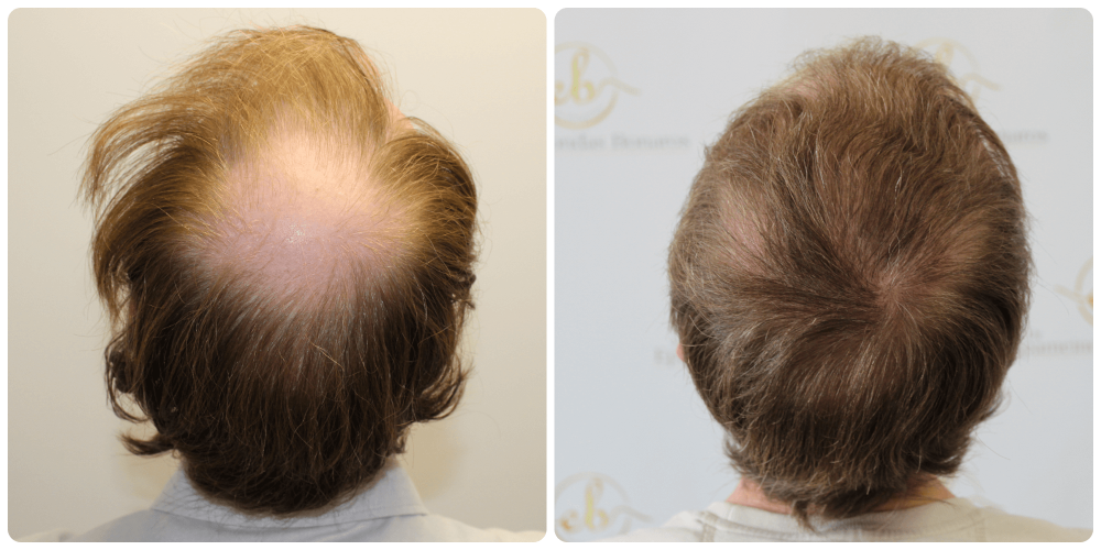 Before-after-hair-transplant-dr-bonaros-glasgow.png
