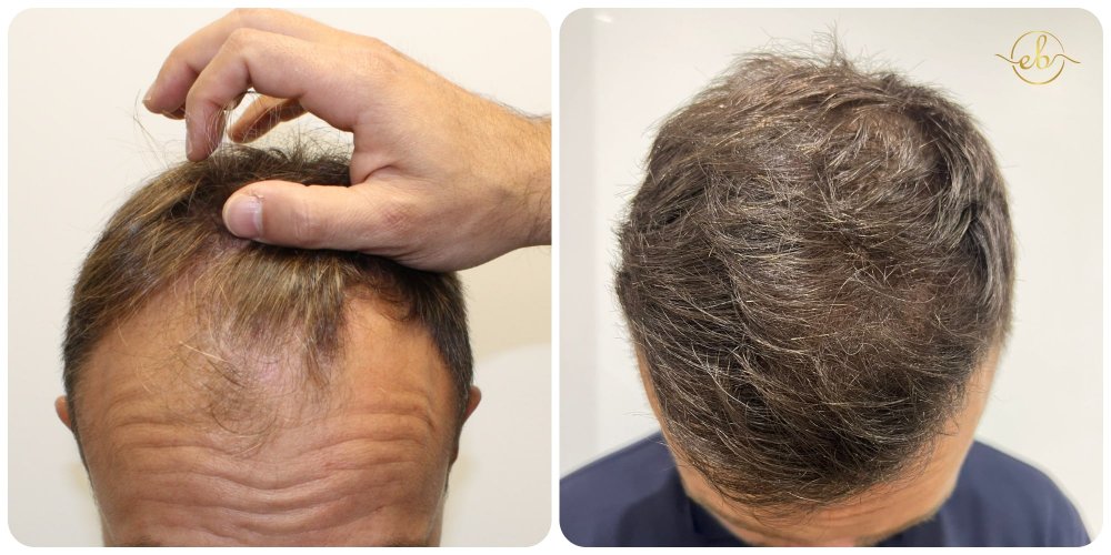 before-after-hair-transplant-results-dr-bonaros-scotland.jpg