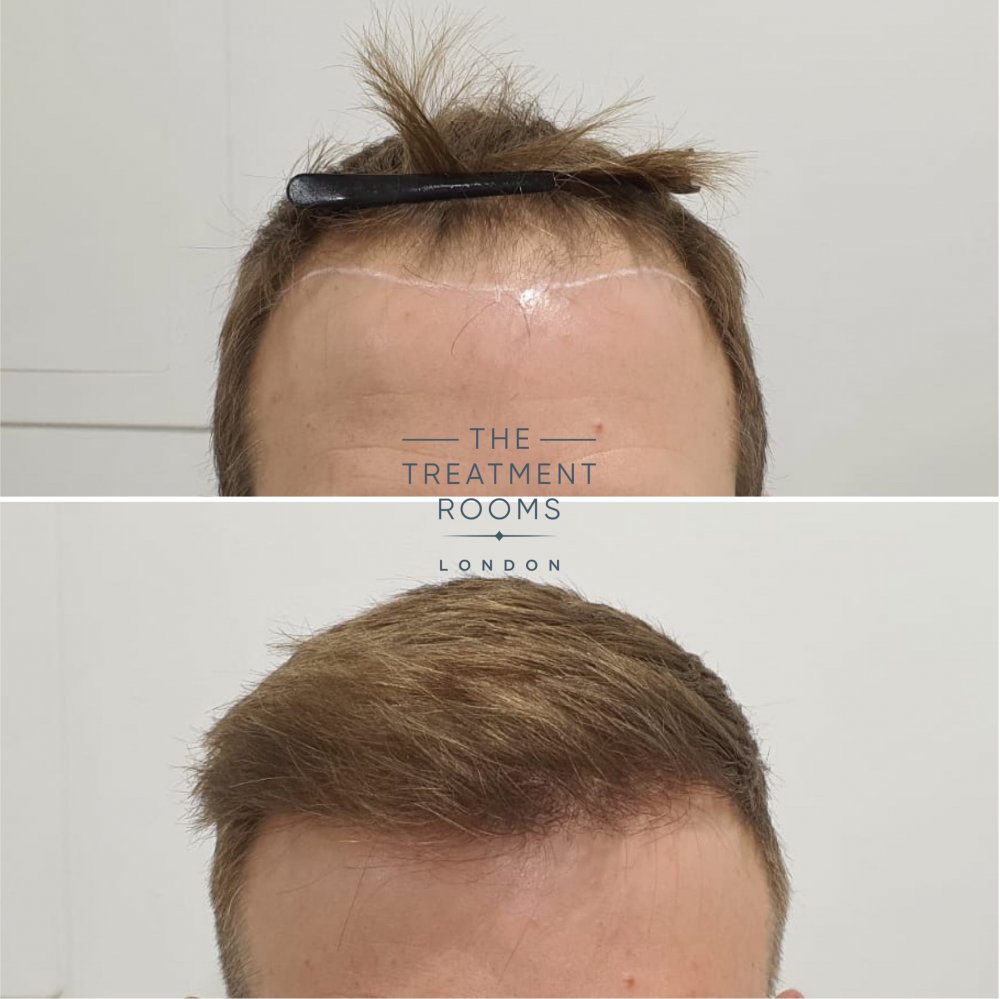 Before and after FUE hair transplant.jpg