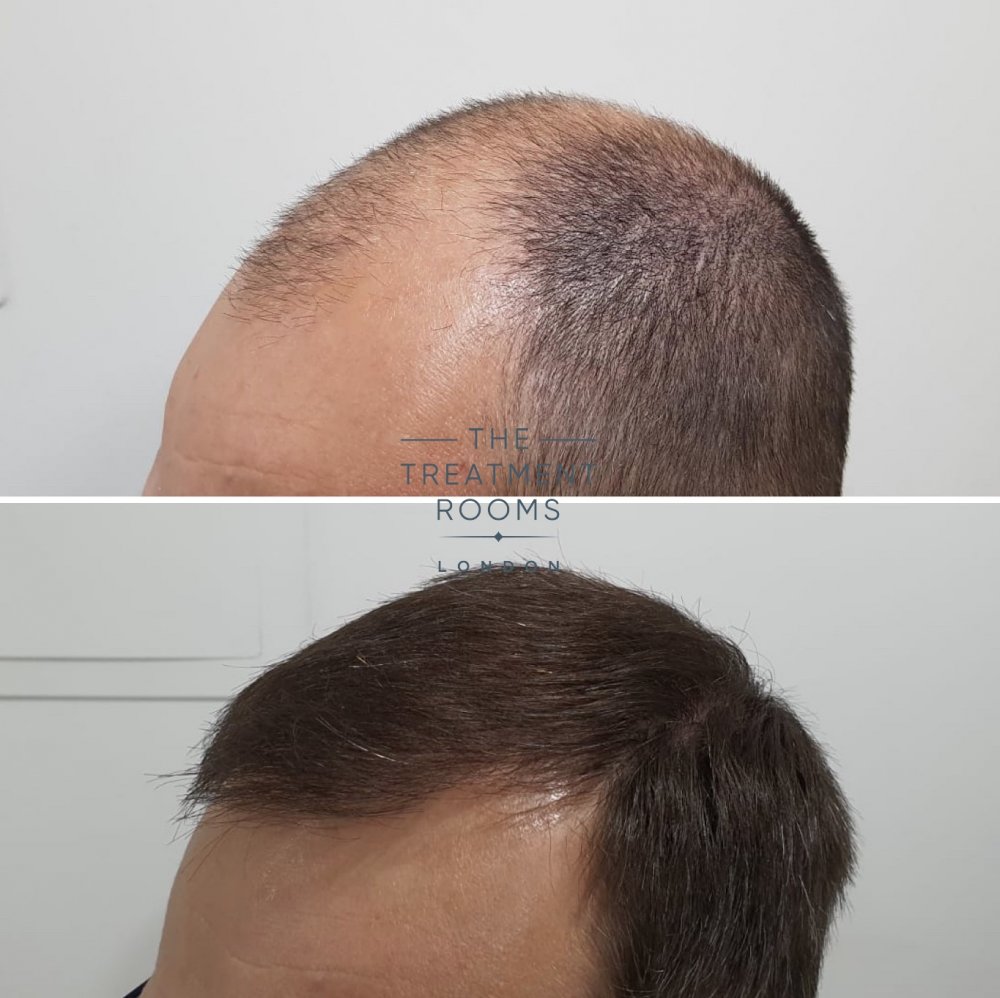 Before and after hair transplant .jpg
