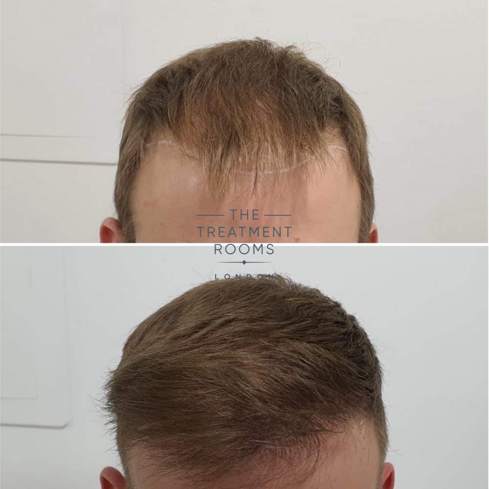 Before and after hairline FUE hair transplant.jpg
