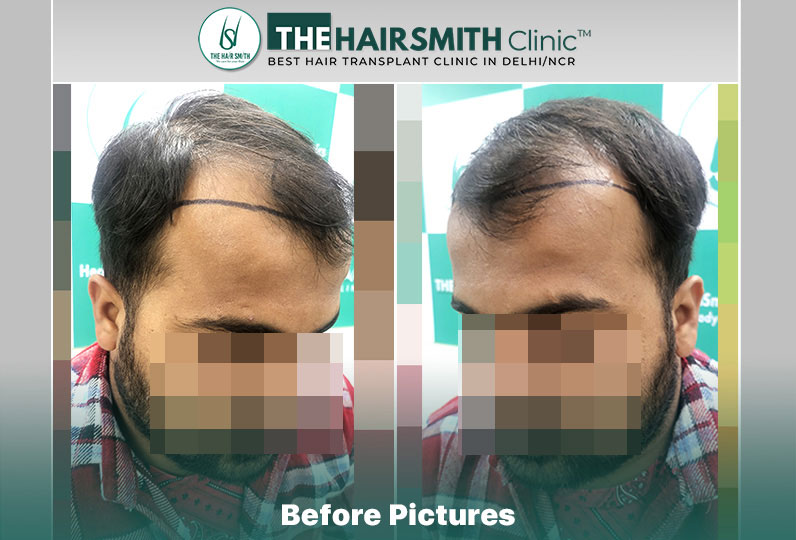 Before Hair Transplant HS 830- The Hairsmith Clinic Delhi India - #hairtransplant #norwoodstage4.jpg