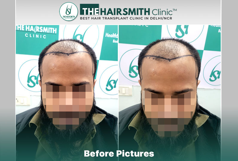 Before Hair Transplant HS 833- The Hairsmith Clinic Delhi India - 1.jpg