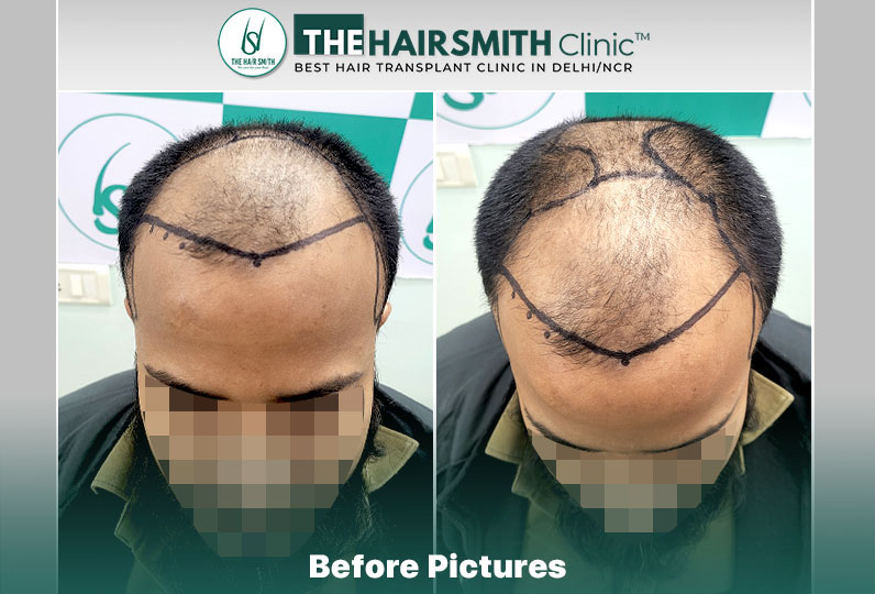 Before Hair Transplant HS 833- The Hairsmith Clinic Delhi India - 2.jpg