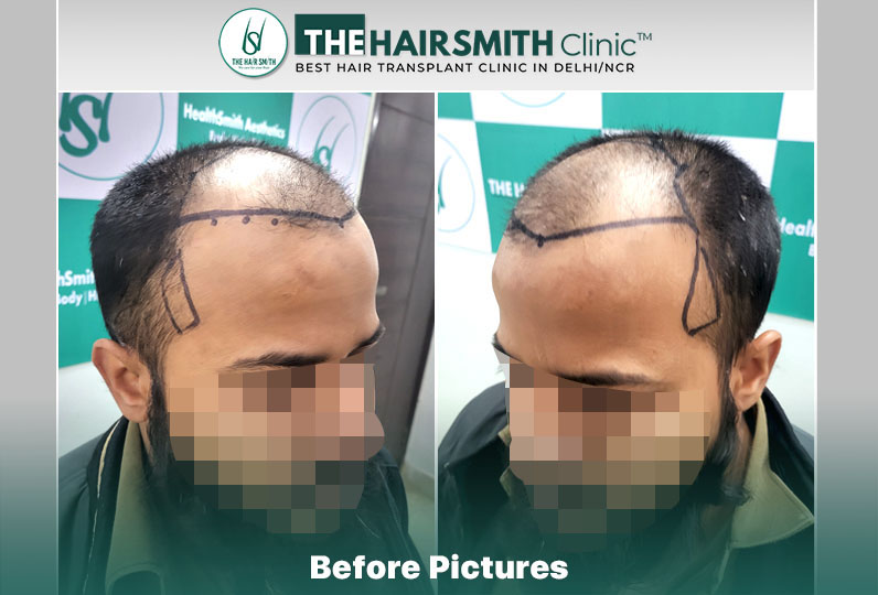 Before Hair Transplant HS 833- The Hairsmith Clinic Delhi India - 3.jpg