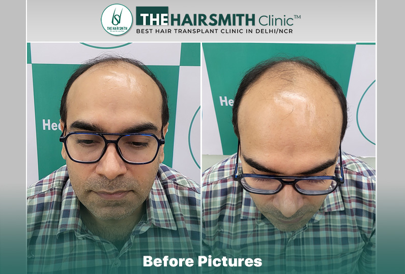 Before Hair Transplant HS 836- The Hairsmith Clinic Delhi India - #hairtransplant #hairlosssta...jpg
