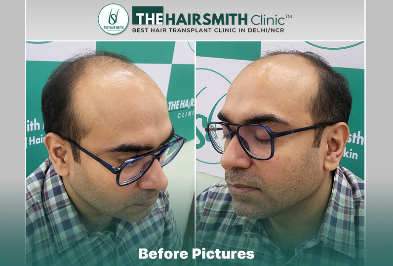 Before Hair Transplant HS 836- The Hairsmith Clinic Delhi India - #hairtransplant #norwoodstage6.jpg