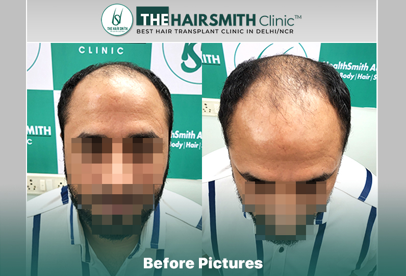 Before Hair Transplant HS 841- The Hairsmith Clinic Delhi India #HairTransplant.JPG