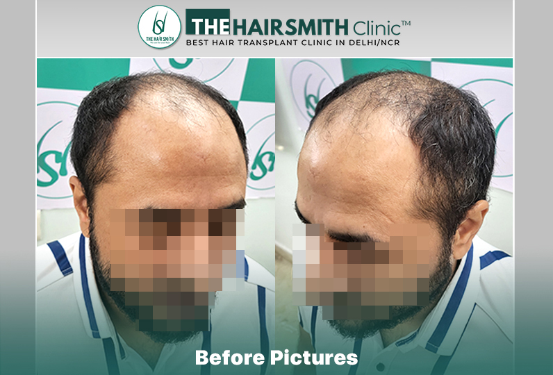 Before Hair Transplant HS 841 - The Hairsmith Clinic Delhi India #HairTransplant #URFUEHairTra...JPG