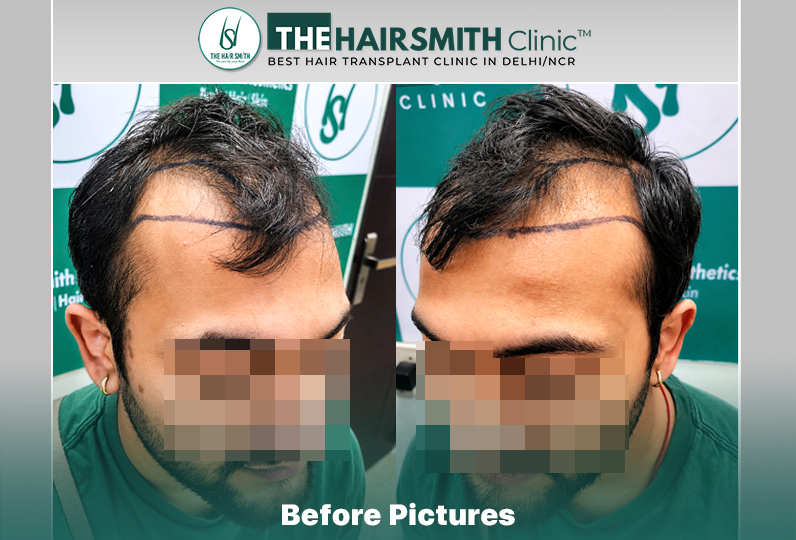 Before Hair Transplant HS 842- The Hairsmith Clinic Delhi India - #hairtransplant #besthairtra...jpg