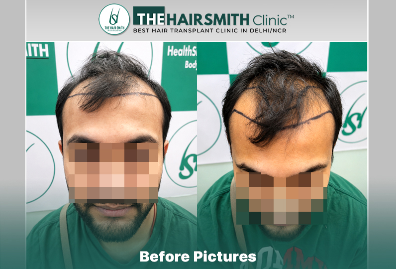 Before Hair Transplant HS 842- The Hairsmith Clinic Delhi India - #hairtransplant.jpg