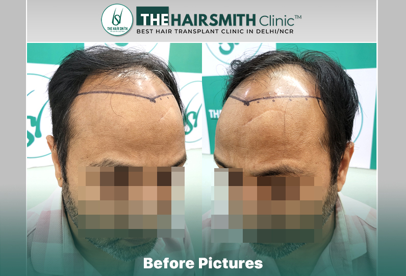 Before Hair Transplant HS 843- The Hairsmith Clinic Delhi India - #hairtransplant #hairregrowth.jpg