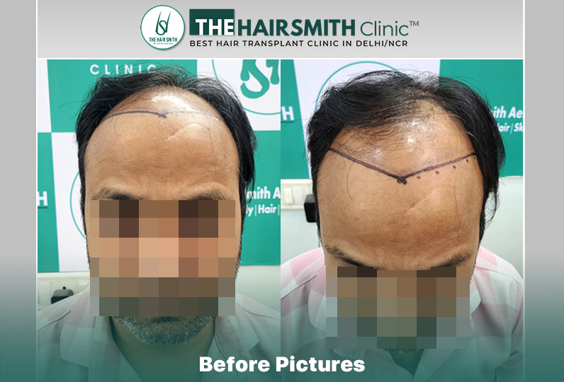 Before Hair Transplant HS 843- The Hairsmith Clinic Delhi India - #hairtransplant.jpg