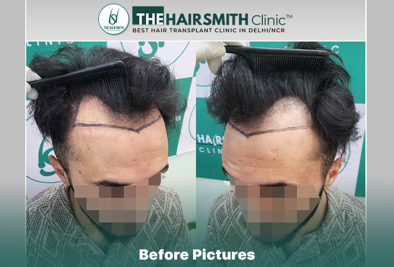 Before Hair Transplant HS 844- The Hairsmith Clinic Delhi India - #hairtransplant #hairregrowth.JPG