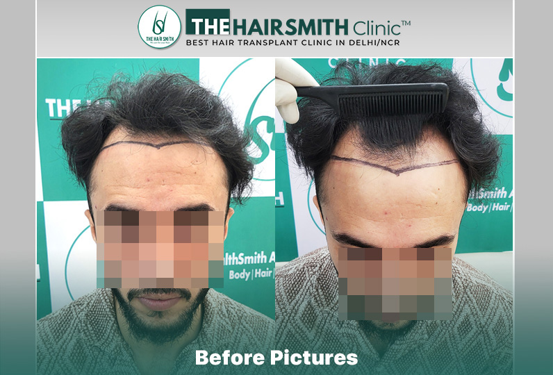 Before Hair Transplant HS 844- The Hairsmith Clinic Delhi India - #hairtransplant.JPG