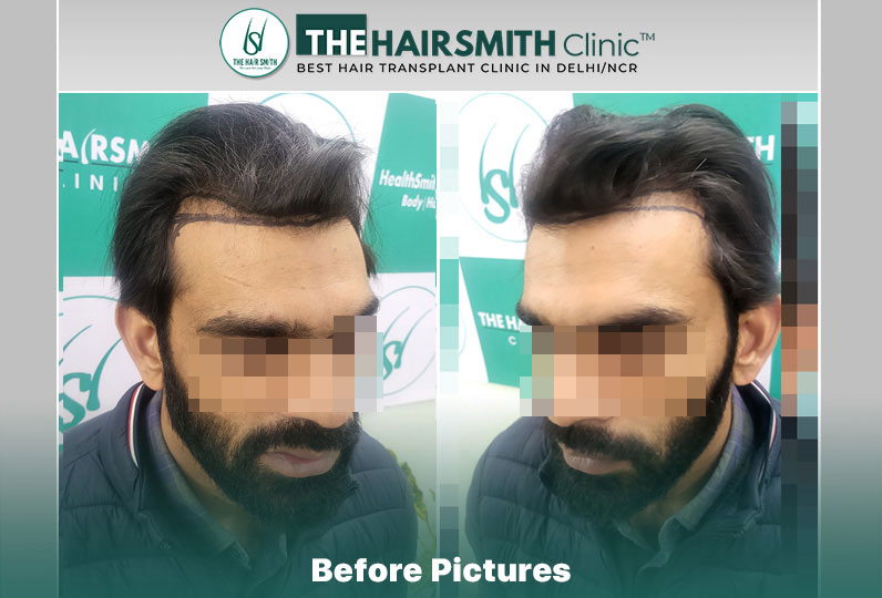 before hair transplant - the hairsmith cliic delhi #hairtransplant #hairlinehairtransplant #ha...jpg