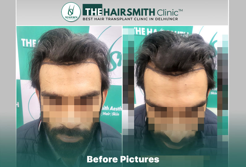 before hair transplant - the hairsmith cliic delhi #hairtransplant #hairlinehairtransplant.jpg
