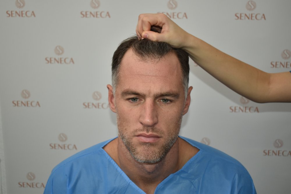 BEFORE HAIRLINE (1).JPG