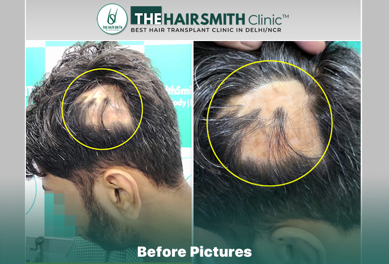 Before Image - The Hairsmith Clinic Delhi India.JPG