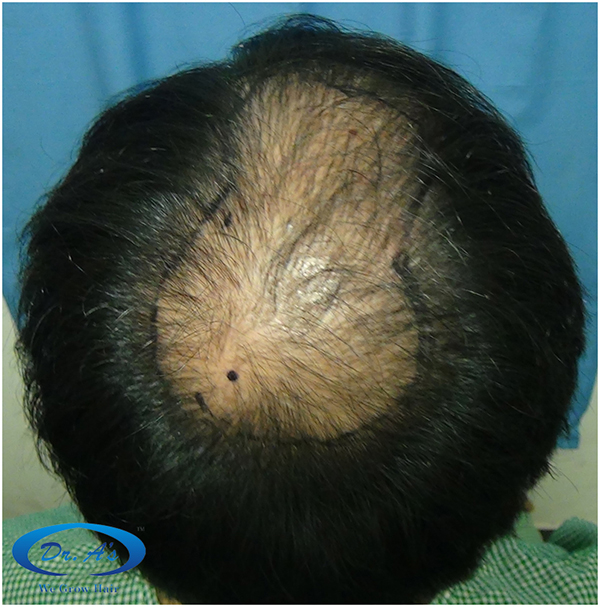 Before picture crown picture.jpg
