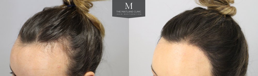Before_After_left_hairline.jpg