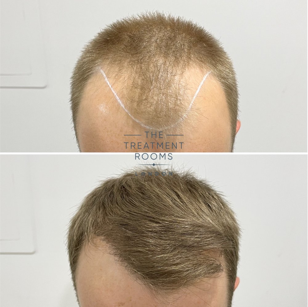 best fue hair transplant clinic london 1756 grafts before and after.jpg