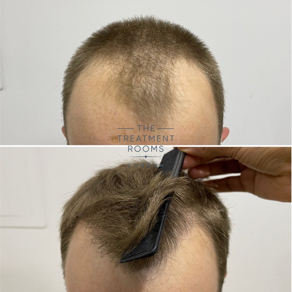 best fue hair transplant clinic london 1756 grafts result.jpg
