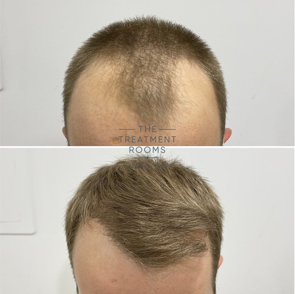 best fue hair transplant london 1756 grafts before and after.jpg