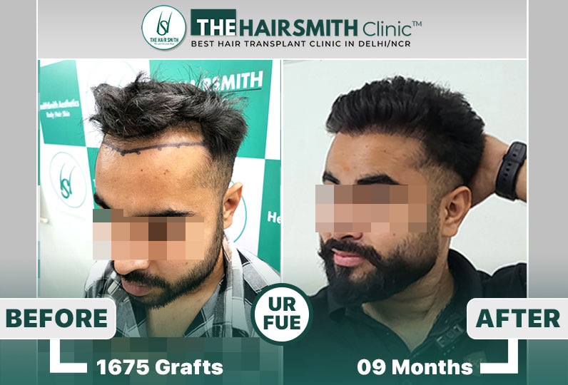best hair transplant clinic in india - after 9 months result - the hairsmith clinic.jpg