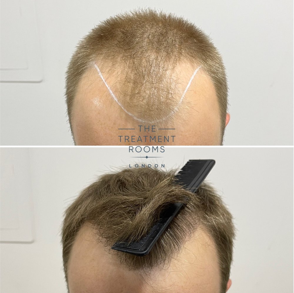 best hair transplant clinic london 1756 grafts result.jpg