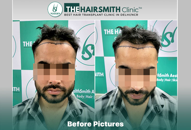 best hair transplant in delhi - the hairsmith clinic.jpg
