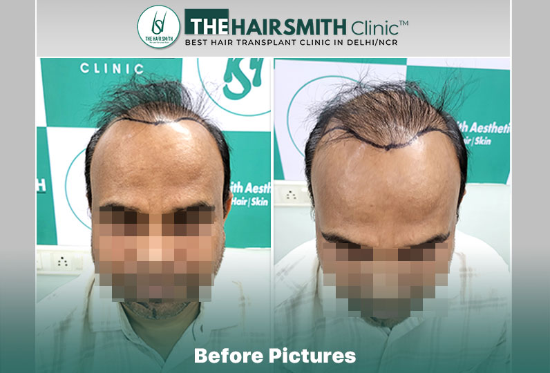 best hair transplant in delhi - the hairsmith clinic.jpg