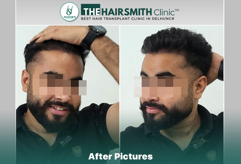 best hair transplant in india - after 9 months result - the hairsmith clinic.jpg