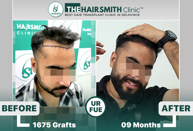 best hair transplant result - the hairsmith clinic.jpg