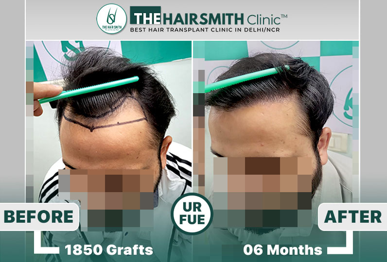 best hair transplant results in delhi.jpg