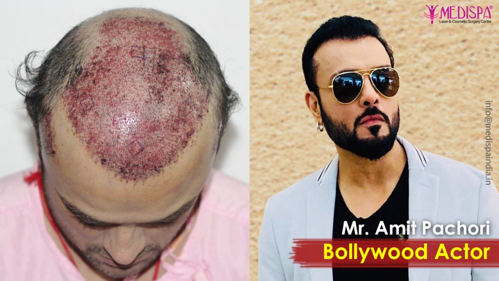 best-hair-transplant-results-in-india-1.jpg