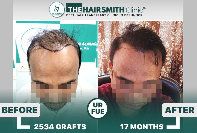 best hair transplant results in india - the hairsmith clinic.jpg