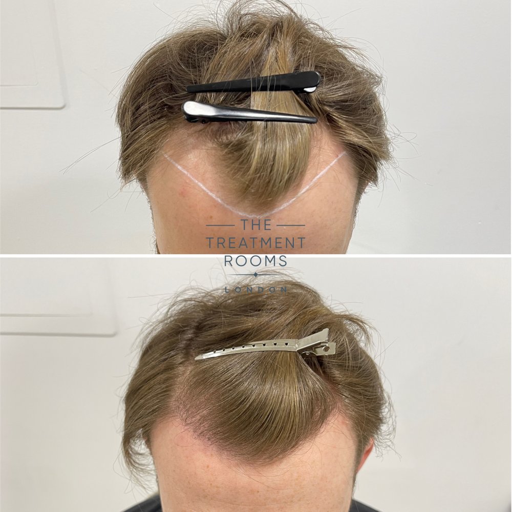blonde hair fue hair transplant before and after 1700 grafts.jpg