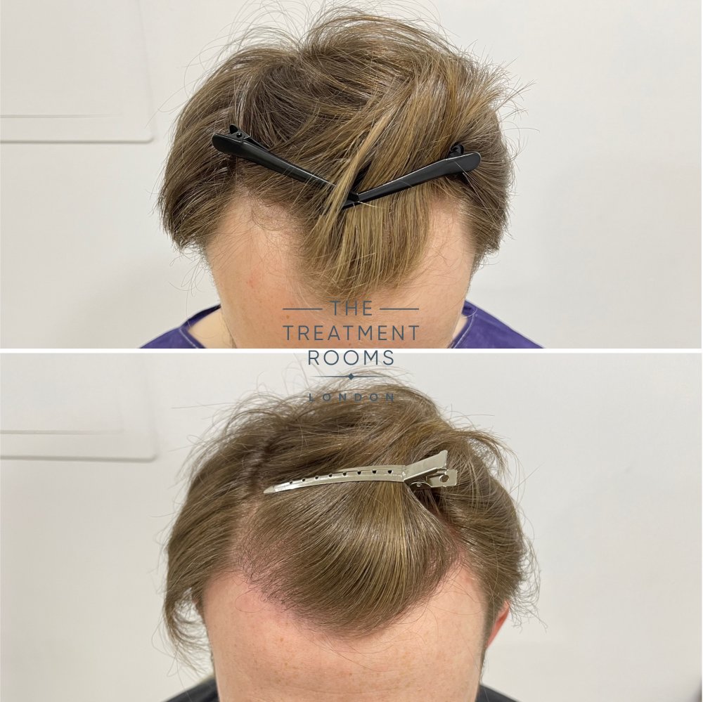 blonde hair fue hair transplant result 1700 grafts.jpg