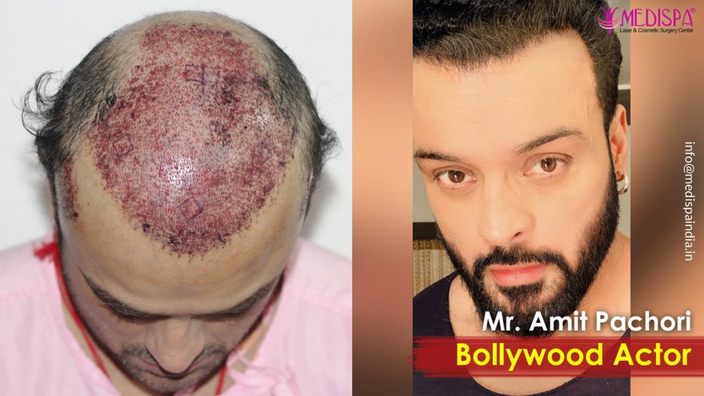 bolywood-actor-hair-transplant-india-1.jpg